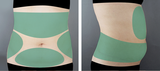 허벅지 지방흡입 수술 전