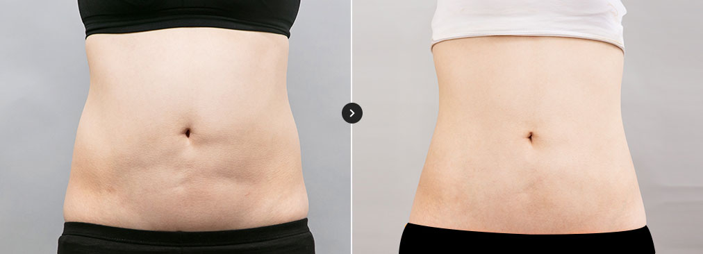 울퉁불퉁한 수술 부위